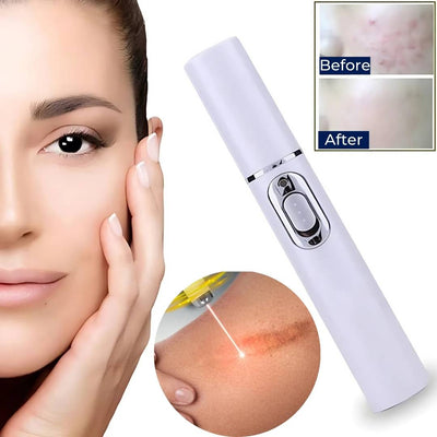 ClearGlow Blue Light Skin Therapy Pen | Acne Treatment - Anti-inflammatory - Non-invasive Solution - Clearer Skin - Blemish Reduction