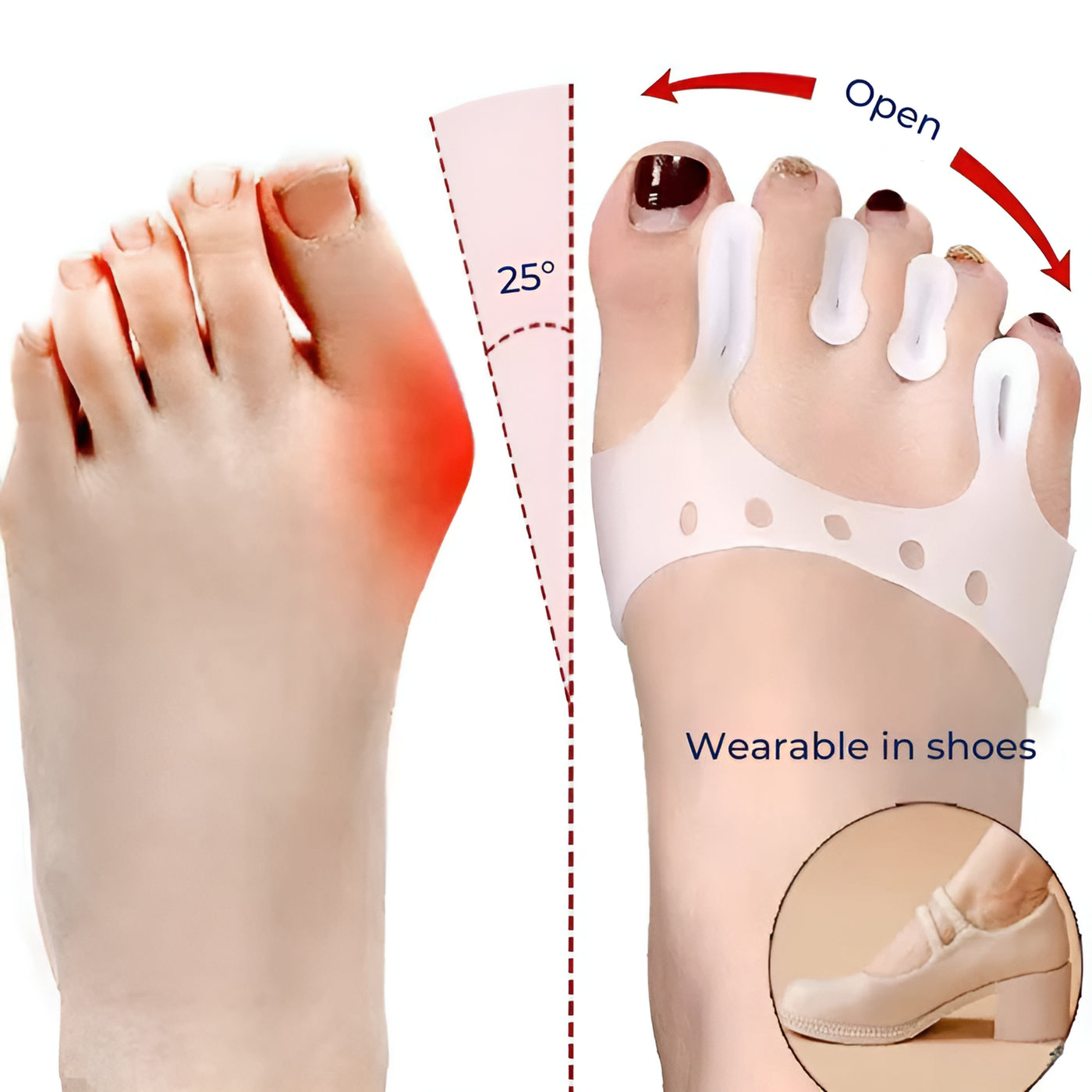 AlignStep | Toe Separator Metatarsal Pad – Pain Relief – Soft Silicone Cushioning – Improves Alignment – All Day Comfort