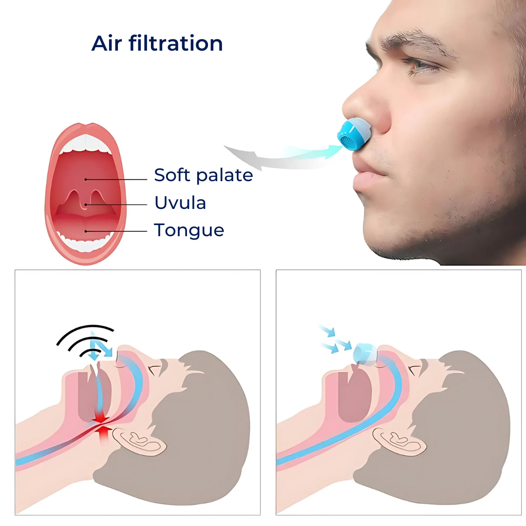 SilentEase | Anti-Snore Nasal Dilators – Snoring Relief – Soft Silicone – Comfortable Fit for Adults
