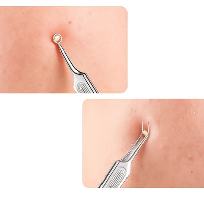 PurePore | Blackhead Removal Tool – Precision Stainless Steel – Easy to Rinse and Maintain - Gentle Pimple Extraction for Home Use