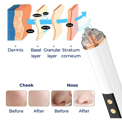 GlowEase | Microdermabrasion Kit – Blackhead Remover – USB Rechargeable – At-Home Skincare Solution
